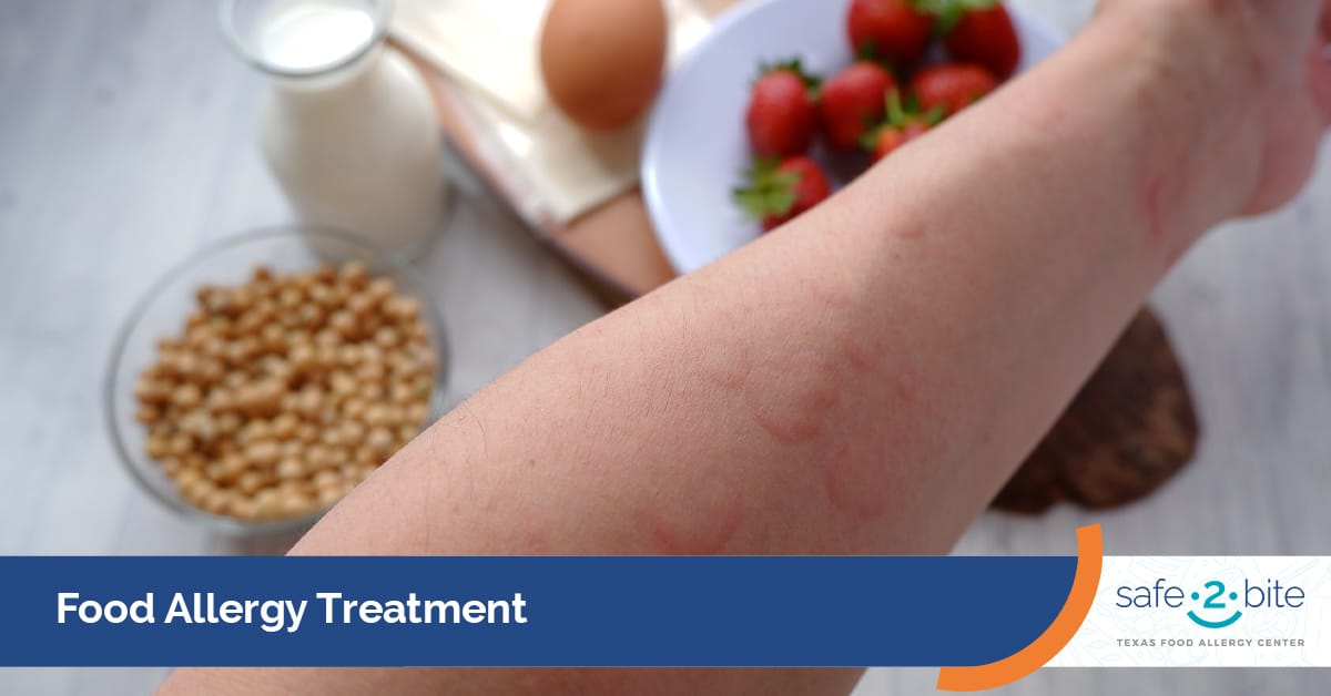 DFW Best Food Allergy Treatment Options Serving North Texas – Safe2Bite ...