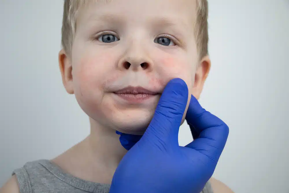 DFW pediatric allergist.